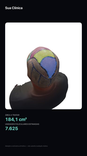 Cartão exportado pelo Graftlas: modelo 3D do couro cabeludo com as zonas pintadas, área de 184,1 cm² e estimativa de 7.625 unidades foliculares, com a marca da clínica no topo.